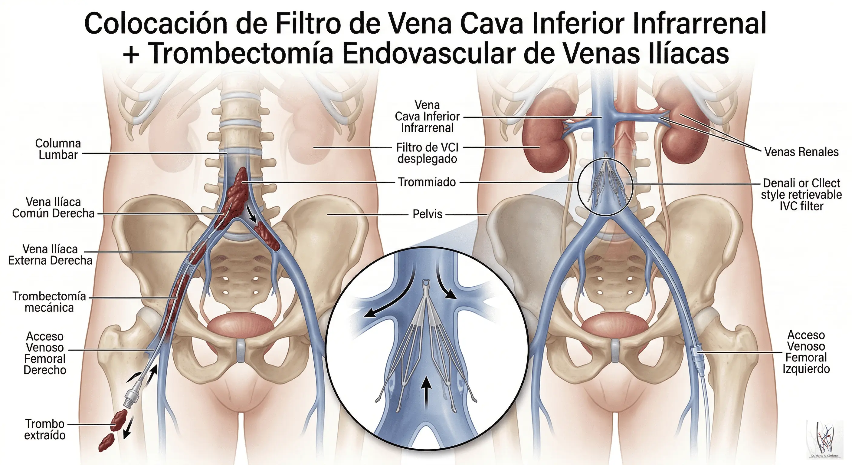 Trombectomía Endovascular